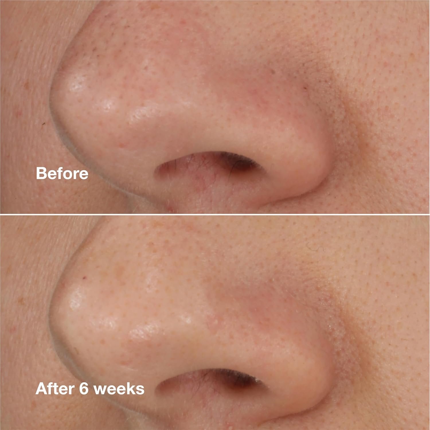 Clinique Blackhead Solutions Self-Heating Blackhead Remover With Salicylic Acid For All Skin Types, 0.68 Fl Oz - Image 5